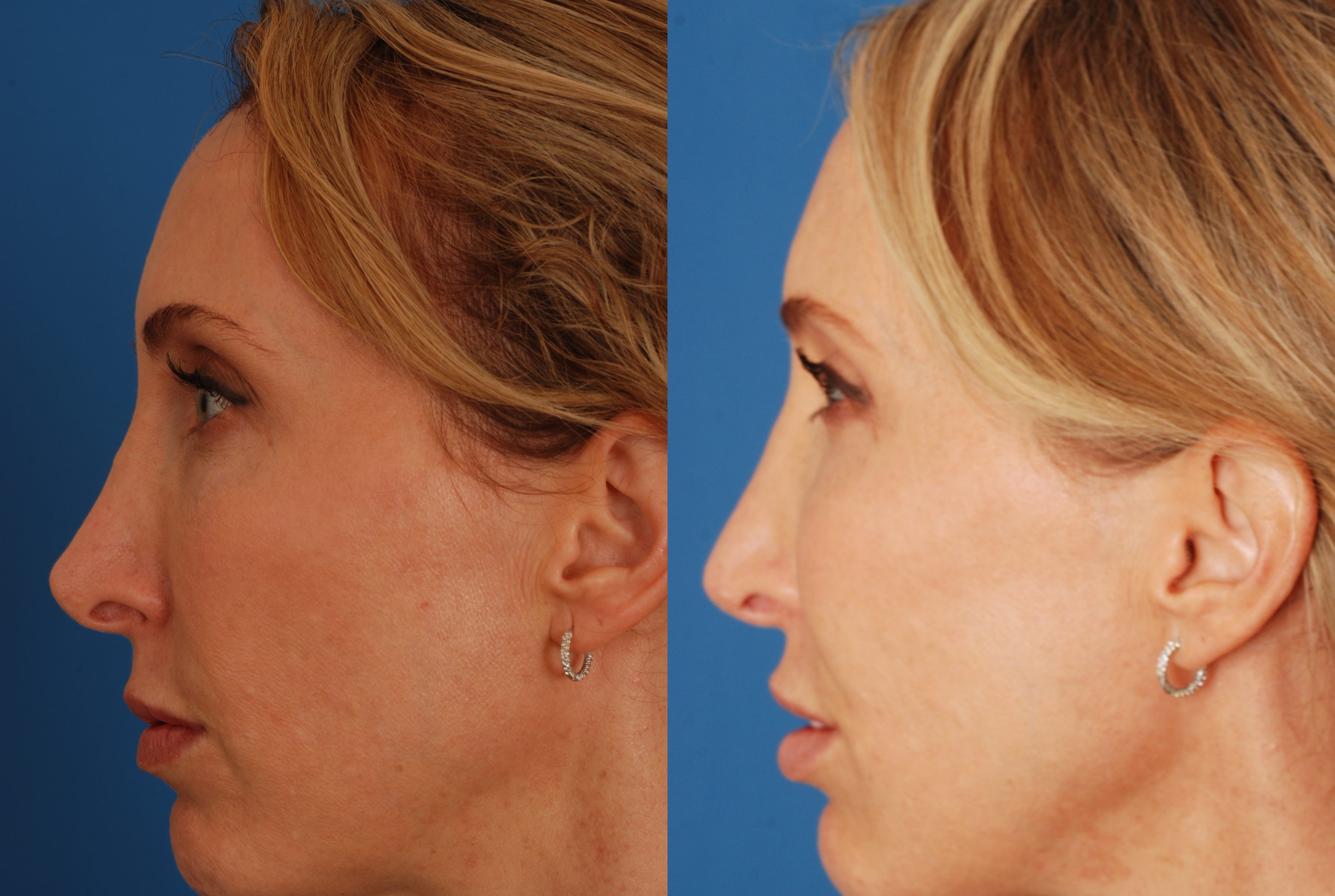 20130523135309284.dc Bassichis Revision Rhinoplasty – Dallas Advanced ...