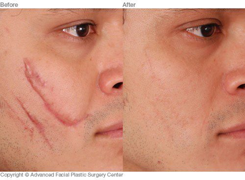 scar-revision-dallas-advanced-facial-plastic-surgery-center