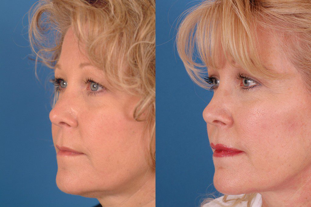 Minilift | Advanced Facial Plastic Surgery Center