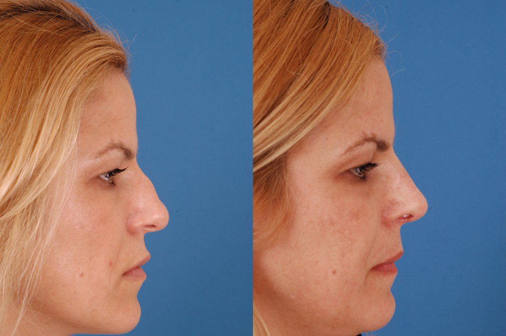 REVISION-RHINOPLASTY-8 – Dallas Advanced Facial Plastic Surgery Center