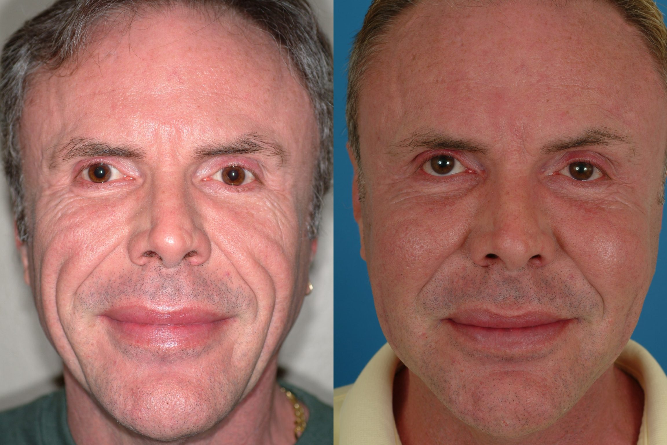 Ластика лица у мужчин до и после